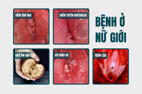 sung-vung-kin-benh-gi-va-khac-phuc-the-nao-hieu-qua-1