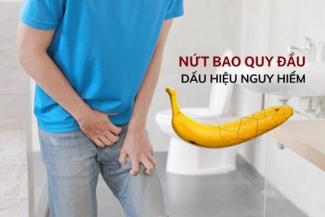 Nứt bao quy đầu có nguy hiểm không và cách điều trị hiệu quả