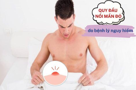 Quy đầu nổi mẩn đỏ nguyên nhân tác hại và cách xử lý hiệu quả