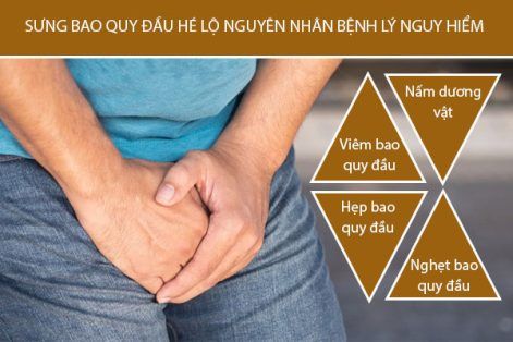 Sưng bao quy đầu hé lộ nguyên nhân bệnh lý nguy hiểm