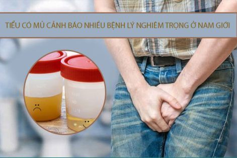 Tiểu có mủ cảnh báo nhiều bệnh lý nghiêm trọng ở nam giới